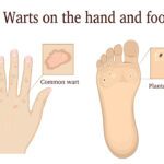 Warts