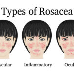 rosacea