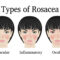 rosacea