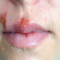 Cold Sores