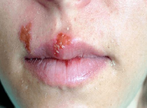 Cold Sores: Causes, Symptoms and Risk Factors