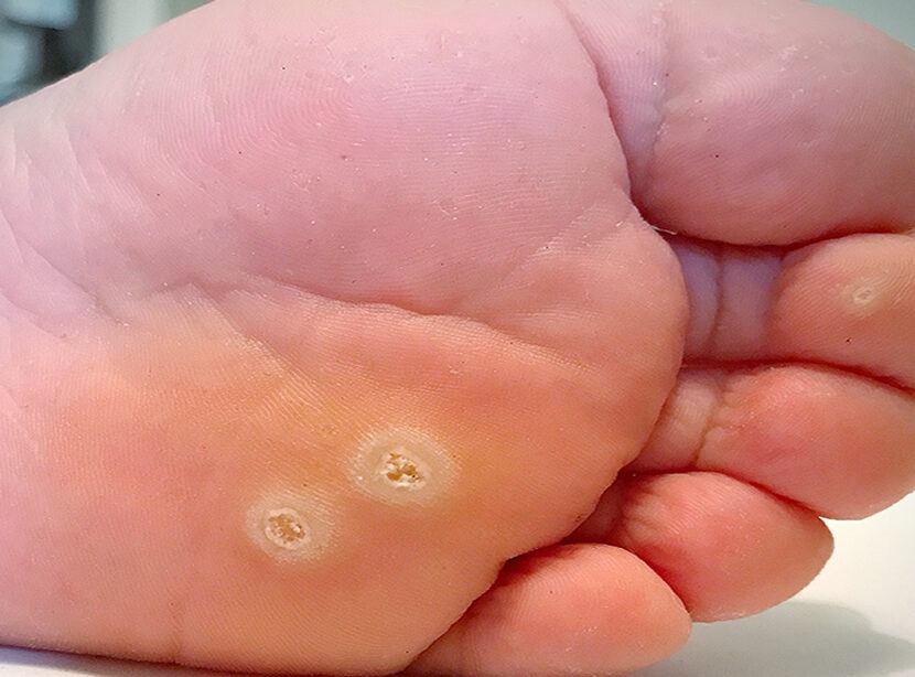 Warts: Causes and Types - HomeoHeals