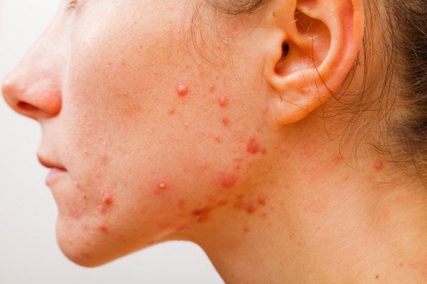 Moderate acne